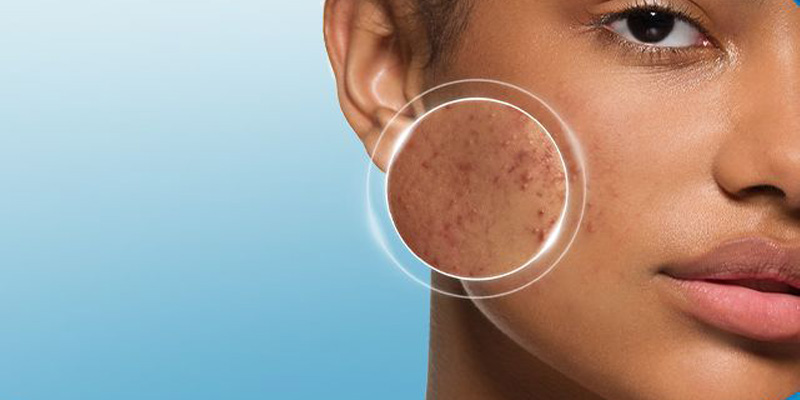 cetaphil-untuk-jerawat-membandel